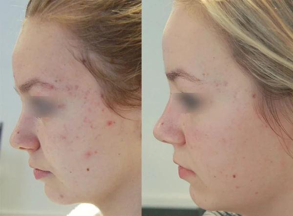 Fruitzuurpeeling in Oss